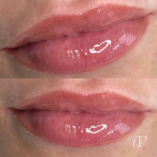Healed Nanolips!!! ✨

This is a modern and gentle semi-permanent lip nanopigmentation technique designed to enhance the natural colour, shape, and symmetry of your lips.

Using an ultra-fine nano needle, Nanolips delivers soft, pixelated organic pigment into the lips with minimal trauma and faster healing 😍

Perfect for those who want a natural tint and more defined borders with soft finishing. That’s NOT a tattoo or lipstick effect.

It’s essencial to book a first consultation to understand the steps, before and after care, and also to align the details for a better result. Every skin tone and healing process work differently.

Appointments & Courses: Link in Bio.
3+4 Young Street, Neutral Bay | Sanctuary Skin Care Clinic.
.
.
.
🇧🇷Nanolips cicatrizada!!! ✨

Essa técnica moderna e suave de nanopigmentação labial, desenvolvida para realçar a cor, o formato e a simetria natural dos lábios.

Usando uma nanoagulha ultrafina, a técnica Nanolips aplica pigmento orgânico de forma suave e pixelada nos lábios, com o mínimo de trauma e cicatrização mais rápida 😍

Perfeito para quem deseja uma coloração natural e contornos mais definidos com acabamento suave. NÃO é um efeito de tatuagem ou batom. 

✨ É essencial agendar a Consulta de Avaliação para entender os passos dos cuidados antes e depois, e também para alinhar os detalhes para um melhor resultado. Cada tom de pele e processo de cicatrização funcionam de formas diferentes.

Agendamentos & Cursos: Link na Bio.
3+4 Young Street, Neutral Bay | Sanctuary Skin Care Clinic.
