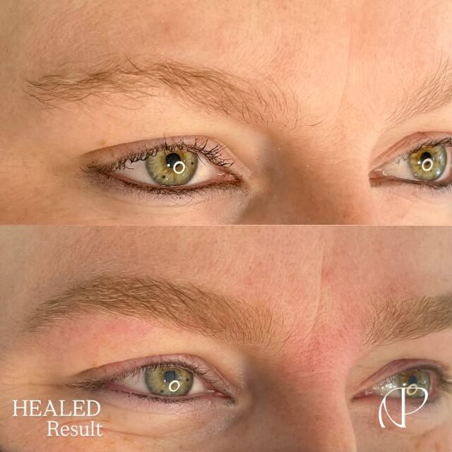 HEALED BLUE BROWS? NO! 👀✋🏼

No “50 shades of grey”, no bluish tones! Just clean, refined work!

This is one of my favourite healed cases, as my beautiful client has rosacea — a very common skin condition that affects pigmentation and the healing process. Her skin is highly sensitive and tends to become inflamed easily. The procedure must be performed efficiently, following a specific protocol to properly manage the skin.

I’m planning to open a limited schedule in New Zealand. Is anybody there?! 👋🏼