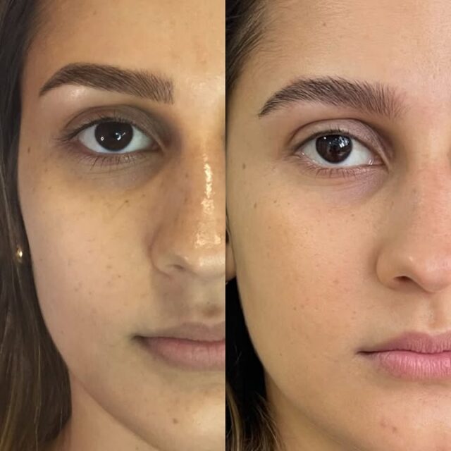 Vamos de “antes e depois”? Ela removeu para fazer de novo! [leia]

Sabemos que gosto não se discute, mas cabe à nós sempre trazer a informação clara para vocês. 

Nós sabemos o quanto vocês adoram acompanhar os casos que atendemos em nossos studios e este aqui foi um caso muito legal da Isa, uma cliente da Ágatha desde 2017, ano em que realizou a sua primeira micropigmentação com a técnica Microblading fio a fio conforme a primeira foto.

Desde então, a Isa havia realizado 4 procedimentos de micropigmentação com suaves retoques, mas este ano (2023) decidimos que era hora de recomeçar. Foi aí que a Vanessa Galiotto entrou para essa história e botou a mão na massa.

Juntas, entendemos que era hora de remover o residual de pigmentos da época e também atualizar o design que havia sido realizado, para que pudéssemos executar a técnica de Nanopigmentação com maior naturalidade e sofisticação no resultado cicatrizado, condizendo com o gosto e estilo atual da cliente.

A Isa amou. Nós amamos e tudo ficou alinhado com a beleza e marca pessoal dela. Foi um processo muito seguro e legal de acompanhar, pois à medida que a saúde estética evolui, nós amamos nos desafiar e trazer isso de forma muito transparente para nossas clientes que acompanham as tendências e enxergam os avanços de tecnologia e de nossas habilidades. 

Obrigada pela confiança, inclusive. Nossas clientes fazem parte e merecem nosso melhor sempre!

Agora nos conta, o que acharam dessa mudança? Vocês fariam?
.
.
.
Agendamentos & Cursos: 📲 (51) 99561-1348. 
————————————————
STUDIO AP & CO  @studioapco 
.
.
.
#studioapco #nanoblading #esteticafacial #esteticaavancada #laserterapia #protocolodereconstrucao #saudeestetica