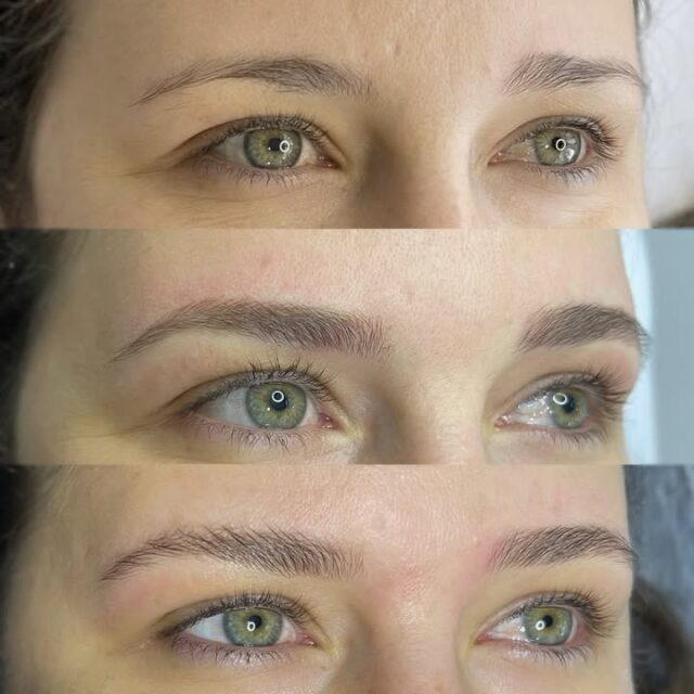 CICATRIZADA SEM BOTOX ‼️

Eu até compreendo as mulheres que acham o resultado cicatrizado da Nanopigmentação natural até demais. Nós viemos de uma era de procedimentos extremamente marcados, inestéticos e eu diria até inesquecíveis 😅

Acontece que a Micropigmentação evoluiu e a percepção estética de muitas clientes em relação ao belo e natural também. Aquilo que antes era padrão passa a ser considerado brega, desapropriado e desconecto com os traços naturais do rosto. 

Antes de via desenhos iguais no rosto de todo mundo. Hoje nem se percebe um pós cicatrizado que harmoniza o rosto sem saber onde e como. 

Meu maior orgulho é as clientes e as pessoas ao redor delas perceberem mudanças sutis e harmônicas sem saber o que foi feito. O natural é isso e por isso sempre digo que NANOPIGMENTAÇÃO de nível elevado não é somente técnica. É um ESTILO!

Neste trabalho de harmonização temos nas fotos da cliente: 1. Antes 2. Pós imediato 3. Cicatrizada após 30 dias (imagens autorizadas).

Encaminha para aquele @ que amaria ter uma sobrancelha assim! 🤎
Isso é arte. Isso é Nanopigmentação!