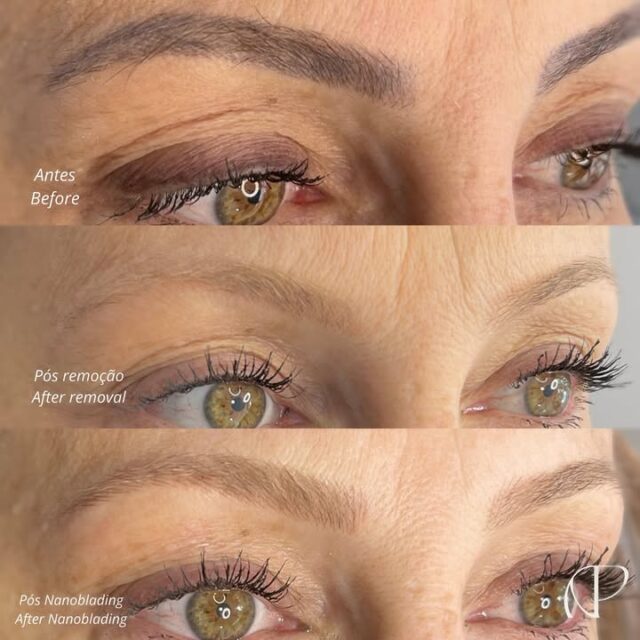 Sobre inícios 🤎

Todo um início significa o fim de algo. Neste final de ano tivemos o privilégio de encerrar o tratamento de dezenas de clientes que sentiam-se insatisfeitas com a sua imagem, especialmente no que se refere as sobrancelhas, moldura tão importante e expressiva para o rosto.

Não se trata apenas de “remover a tinta” e reconstruir o desenho de forma harmônica, mas sim de elevar e fortalecer a confiança de mulheres tão especiais. É isso!

Somos apaixonadas por entender e conduzir este processo, seja de clientes nossas como também de profissionais parceiros. 

Um viva a 2023 e nosso muito obrigada a todos que depositam confiança em nosso trabalho! 

Até 2024 ✨🥂