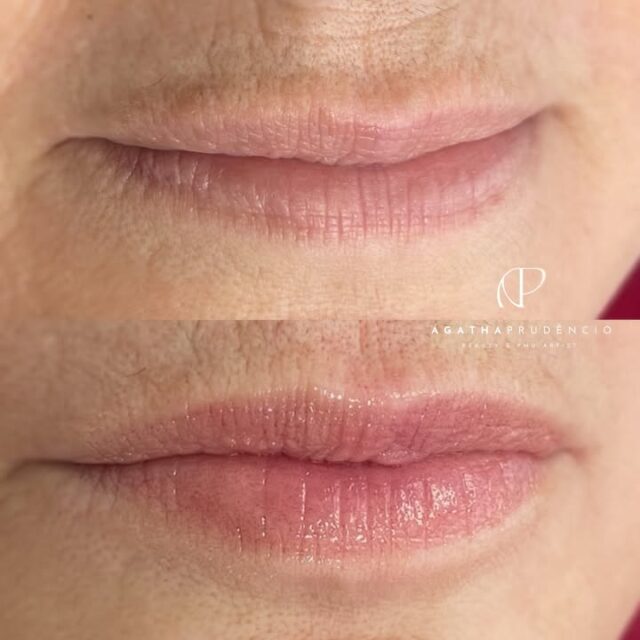 Para quem tem lábios maduros 🤌🏻✨

A Nanopigmentação Labial é uma técnica que encanta nossas clientes por três motivos:

1. A NANOLIPS é uma técnica extremamente suave, com estilo de bordas sem marcação.
2. Sensível a coloração natural e efeito de lábios saudáveis.
3. Técnica rápida e segura na execução, especialmente para lábios com preenchimento.

Está cliente desejava corrigir pequenos detalhes, sem as bordas marcadinhas e realçar aquela cor de “saúde”.

✨ Durabilidade de 8 a 12 meses.
✨ Agendamentos e Cursos, clica no link da Bio | Atendimentos Porto Alegre e Caxias do Sul. 

#studioapco #nanolips #nanopigmentacao #saudeestetica